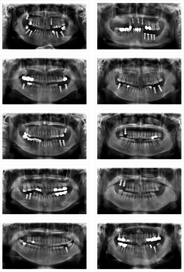 임플란트 시술사례 이미지