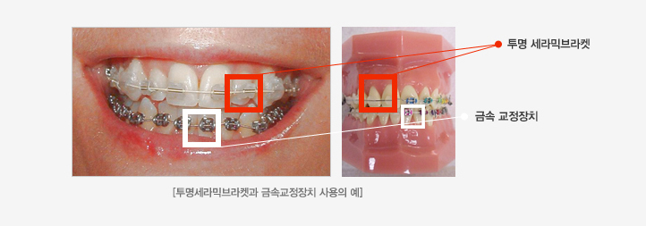 투명세라믹 브라켓 이미지