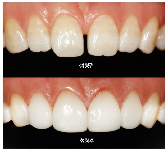 성형전 후 사진