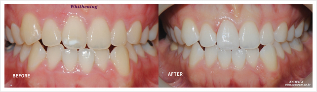 1.충치치료와 스케일링 시린 치료를 먼저 시행합니다./2.치태를 제거 합니다./3.치아주변에 잇몸 보호제를 바릅니다./4.미백 약을 치아 표면에 바릅니다./5.광선을 치아에 약 15분씩 2~3회 조사합니다./6.잇몸 보호제와 미백약을 깨끗이 제거 합니다./7.사진촬영으로 전후 상태를 비교합니다.