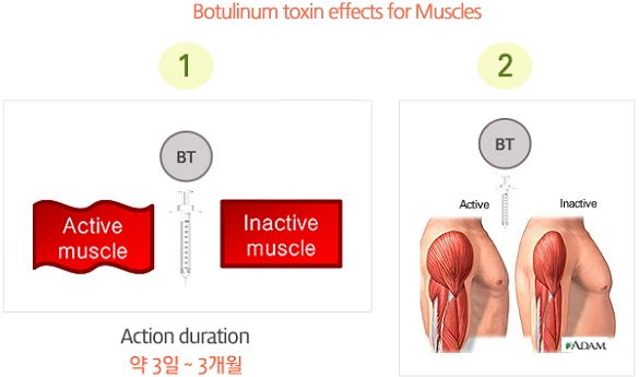 Action duration 약 3일 ~3개월 전후사진